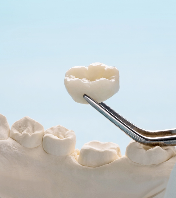 What Are Dental Crowns?
